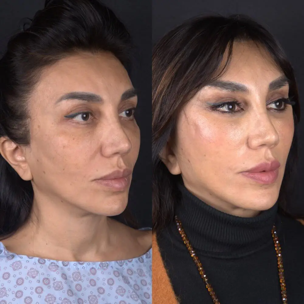 Rezultat inainte si dupa pentru armonizarea profilului facial