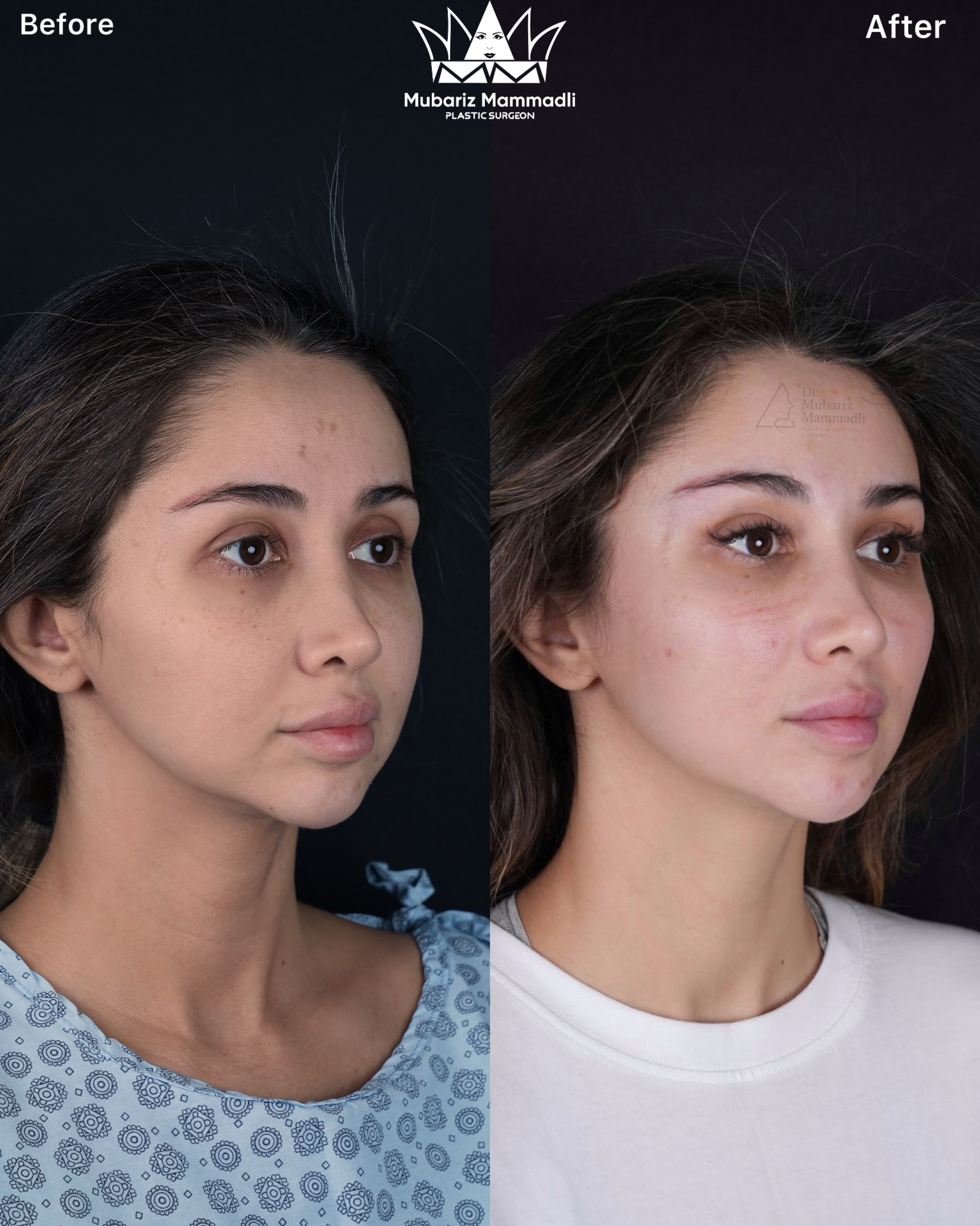 alt= âEndoscopic Midface liftâ