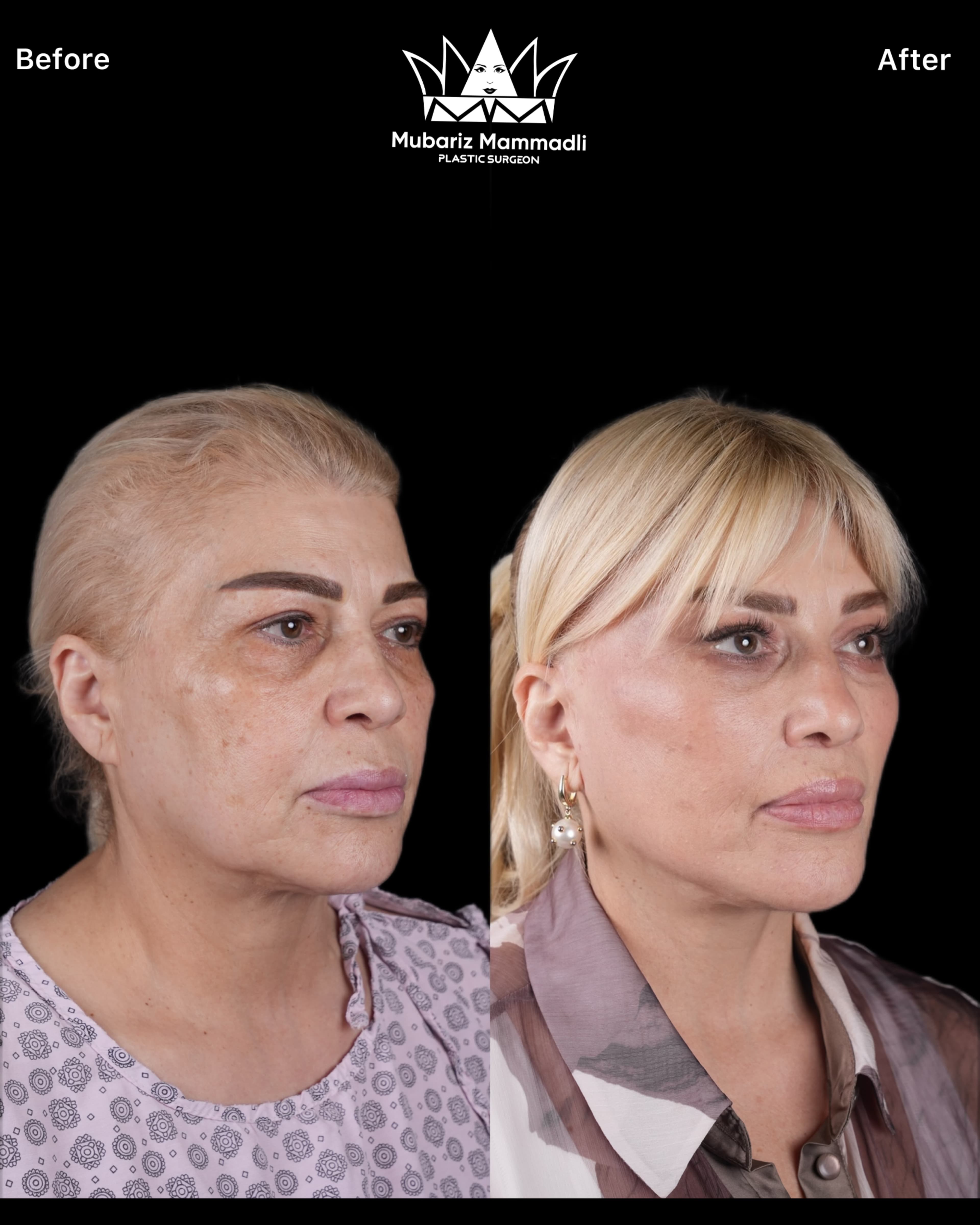 alt= “Natural result face lift”