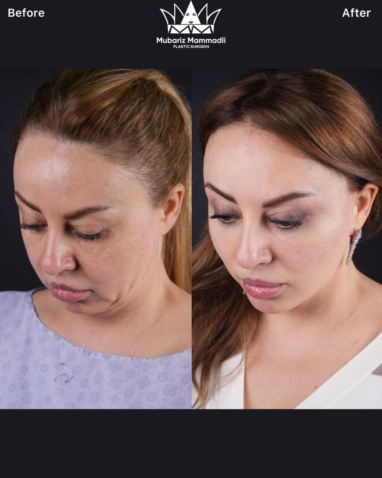 Alt=“facelift”